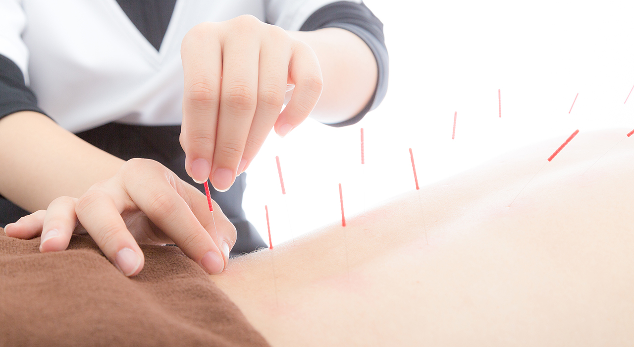 鍼灸師に背中に針を打ってもらう女性